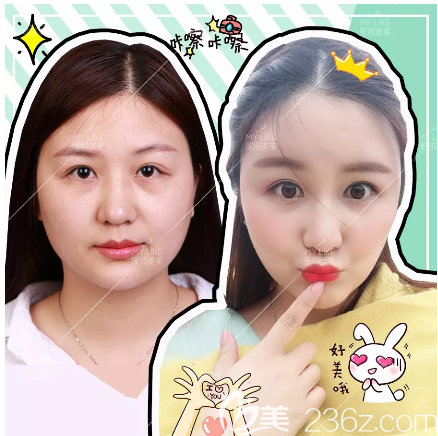 深圳美萊陳磊面部吸脂前后對比圖 深圳美萊陳磊面部吸脂前后對比圖