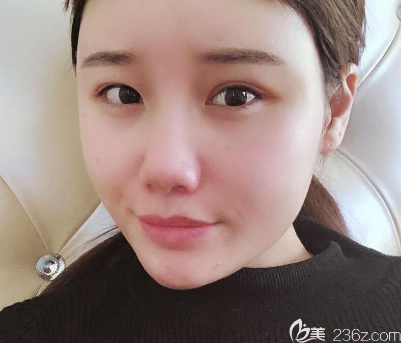 白領(lǐng)安琪兒全臉自體脂肪填充第10天