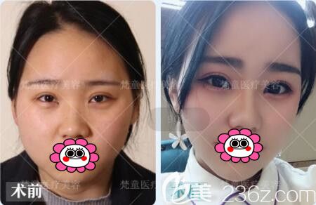 長(zhǎng)沙梵童注射瘦臉瘦臉真人前后對(duì)比