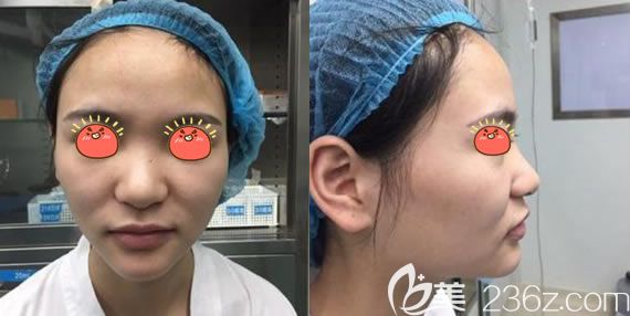 義烏連天美整形做隆鼻手術(shù)前 義烏連天美整形做隆鼻手術(shù)前