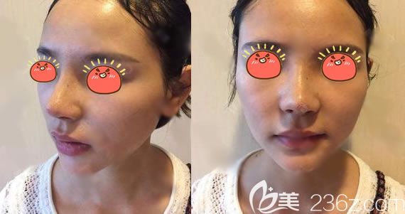 義烏連天美隆鼻<span style= 義烏連天美隆鼻<span style=