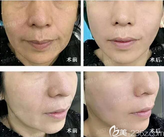 高飛線雕提升案例對比照