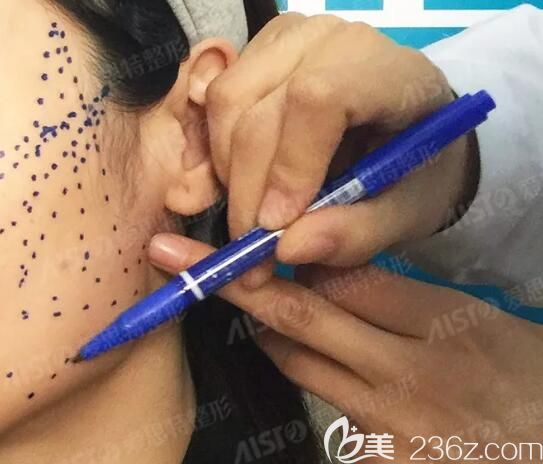 做線雕術(shù)前高飛醫(yī)生劃線設(shè)計