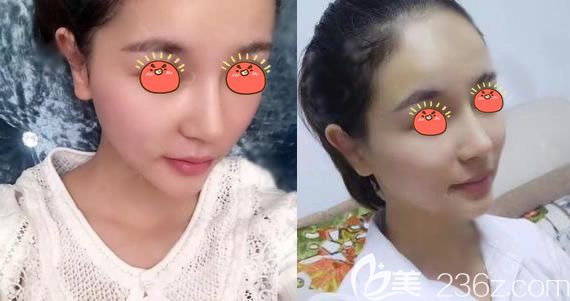 義烏連天美分院做隆鼻<span style= 義烏連天美分院做隆鼻<span style=