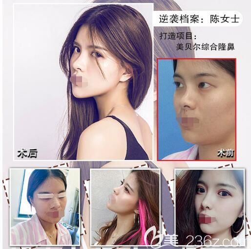 在南京美貝爾做眼鼻綜合分享 在南京美貝爾做眼鼻綜合分享