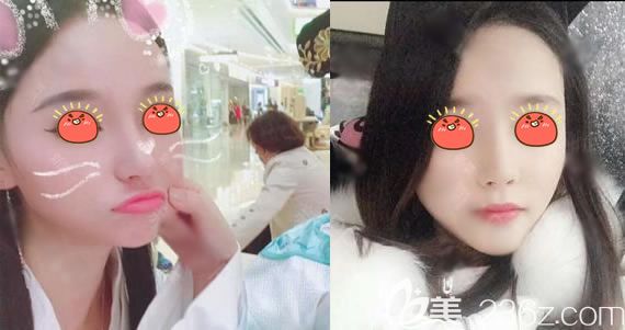 義烏連天美整形假體隆鼻<span style= 義烏連天美整形假體隆鼻<span style=