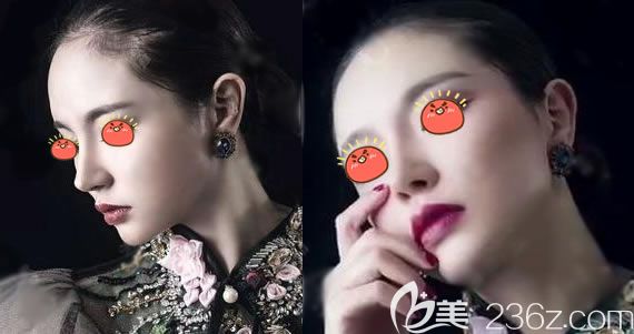 1年前在義烏連天美分院做硅膠假體隆鼻和耳軟骨墊鼻尖的過(guò)程記憶猶新,下面把這回憶錄分享給大家