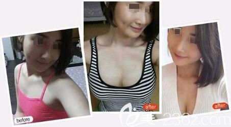 佳木斯韓藝來谷永安隆胸效果