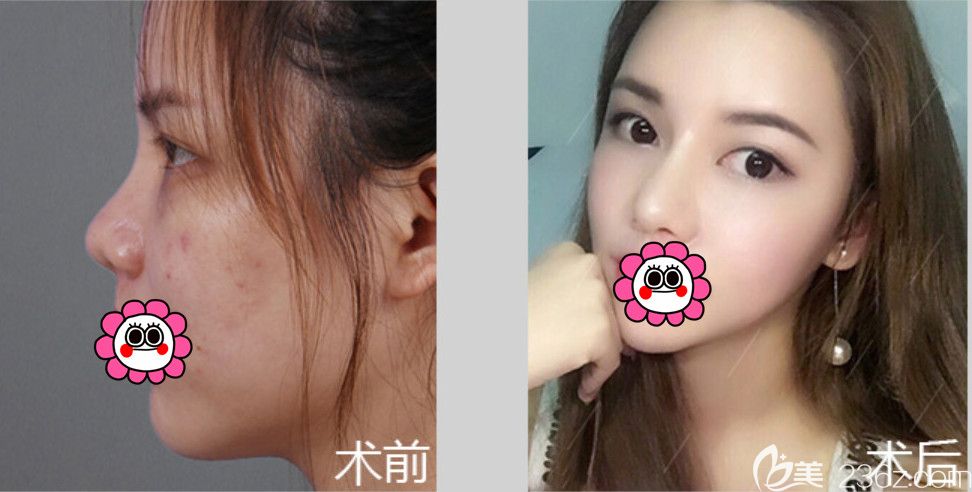 佳木斯韓藝來李明賢鼻綜合整形效果