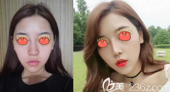 義烏連天美鼻綜合隆鼻<span style=