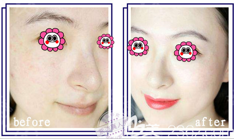 北京紫潔醫(yī)美無(wú)針美膚案例