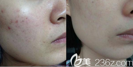 北京紫潔醫(yī)美彩光嫩膚案例