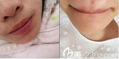 北京紫潔醫(yī)美唇部脫毛案例