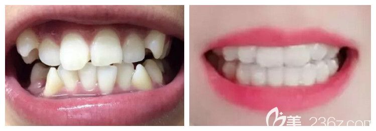 鄭州拜博口腔牙齒矯正案例效果 鄭州拜博口腔牙齒矯正案例效果