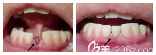 拜博口腔單顆種植牙案例 拜博口腔單顆種植牙案例