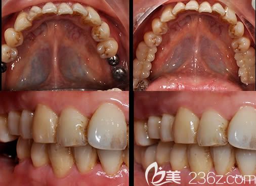 廣州圣貝口腔萬千醫(yī)師種植案例效果對(duì)比圖 廣州圣貝口腔萬千醫(yī)師種植案例效果對(duì)比圖