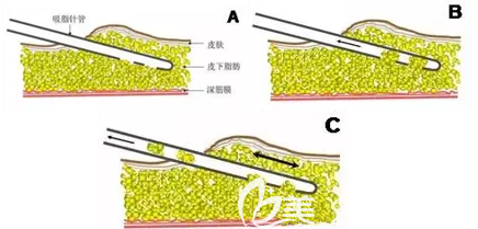 吸脂過程示意圖