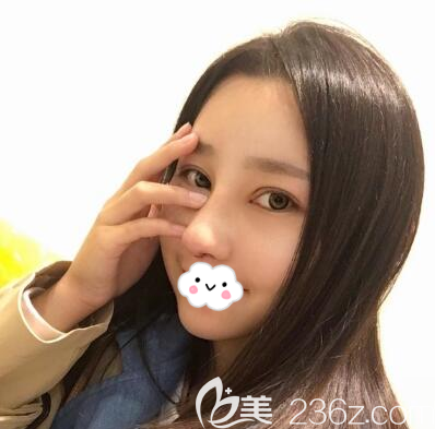 <i data-id='80057854-710c-4b8d-856f-9faaf1974202' style='display:none;'></i>文科隆鼻拆線后效果 <i data-id='80057854-710c-4b8d-856f-9faaf1974202' style='display:none;'></i>文科隆鼻拆線后效果