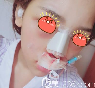 義烏連天美隆鼻<span style=