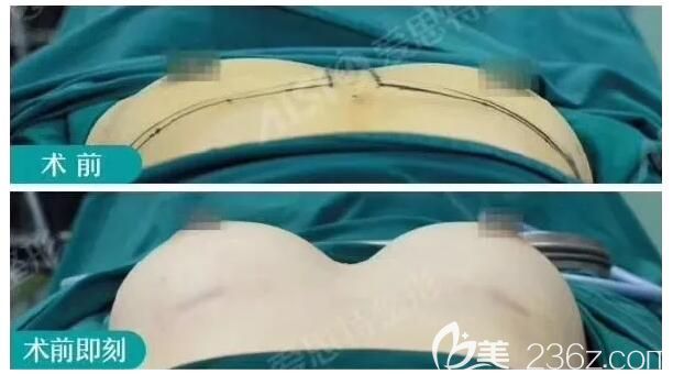 剛做完假體隆胸和術(shù)前效果對比