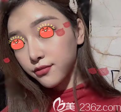 評(píng)價(jià)義烏連天美做鼻子技術(shù)好不好前,先分享一下我做鼻綜合隆鼻手術(shù)的經(jīng)歷和效果給大家