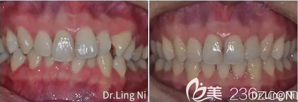 重慶維樂口腔倪靈成人深覆頜矯正案例