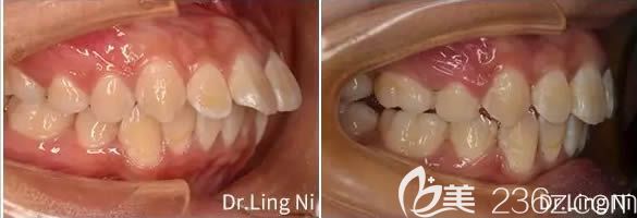 重慶維樂口腔倪靈醫(yī)師牙性+骨性齙牙矯正案例