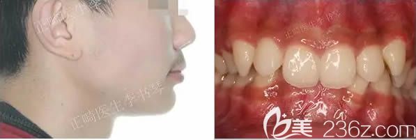 深覆頜矯正前的樣子