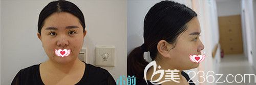 在衡水唯美做耳軟骨隆鼻術前是大鼻頭寬鼻翼 在衡水唯美做耳軟骨隆鼻術前是大鼻頭寬鼻翼