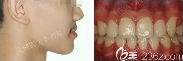 深覆頜矯正后的效果圖