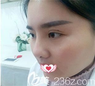 應勝華醫(yī)生為我做耳軟骨隆鼻15天后完全消腫 應勝華醫(yī)生為我做耳軟骨隆鼻15天后完全消腫