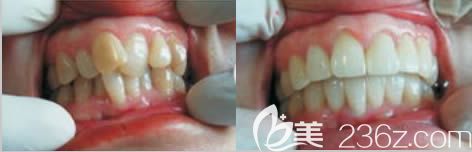 重慶維樂許凈雯成人牙齒輕度畸形矯正前后對(duì)比照