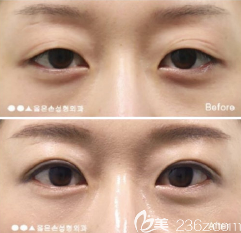 韓國右手整形外科雙眼皮前后效果對比圖 韓國右手整形外科雙眼皮前后效果對比圖
