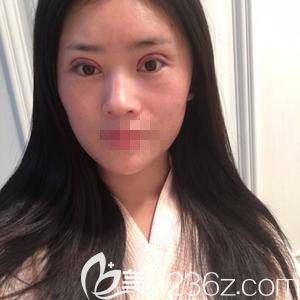 在鄭州華領(lǐng)做自體脂肪填充和眼綜合術(shù)后<span style=