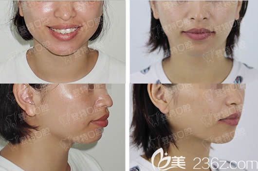 廈門登特口腔正畸前后臉型對比圖 廈門登特口腔正畸前后臉型對比圖