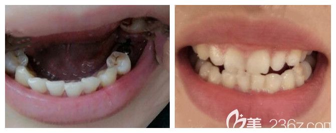 拜博口腔單顆種植牙效果 拜博口腔單顆種植牙效果