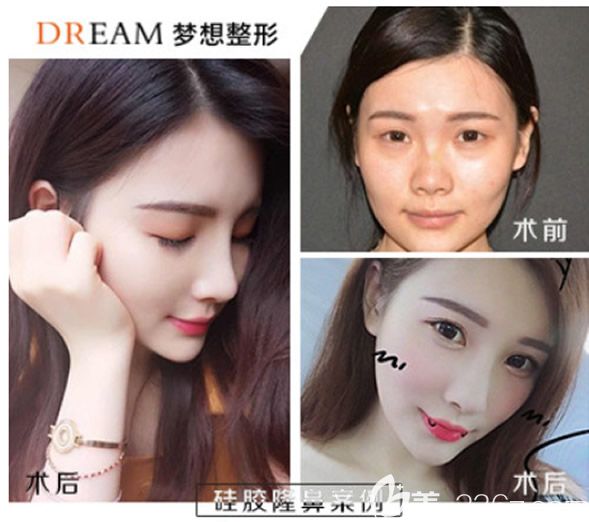 蘭州時(shí)光相伴趙美霞醫(yī)生硅膠假體隆鼻 蘭州時(shí)光相伴趙美霞醫(yī)生硅膠假體隆鼻