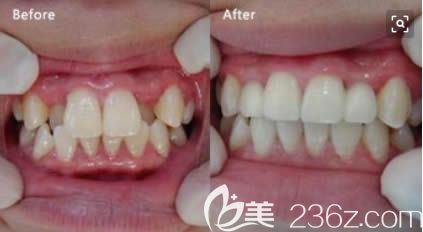 重慶維樂周姣醫(yī)生青少年牙齒擁擠矯正前后對比效果