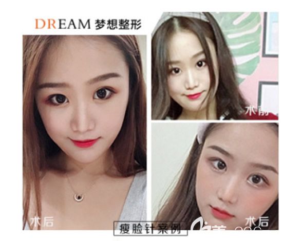 蘭州夢(mèng)想陳元捷隆鼻 蘭州夢(mèng)想陳元捷隆鼻