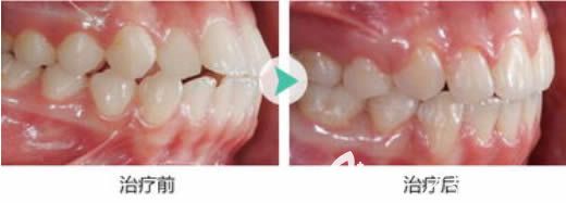 重慶維樂口腔周姣醫(yī)生28歲矯正牙齒前后對比照
