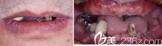 60歲老人在重慶維樂口腔做種植牙術(shù)前照