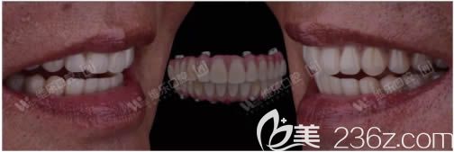 讓劉繼洪醫(yī)生做完全口種植牙后的照片