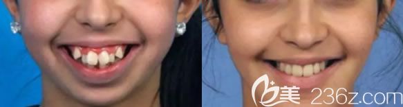 重慶維樂口腔青少年虎牙矯正前后對比效果