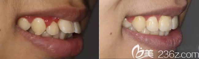 重慶維樂口腔楊國平醫(yī)生青少年深覆蓋矯正前后對比照