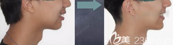深覆蓋矯正后臉型變化圖