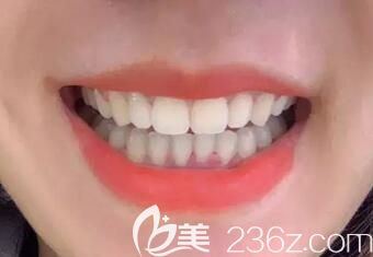 正畸馬拉松結(jié)束,在鄭州拜博口腔做陶瓷托槽矯正后我終于能大方的開(kāi)口笑啦！