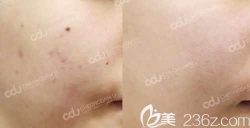 韓國CDU清潭優(yōu)美膚案例 韓國CDU清潭優(yōu)美膚案例