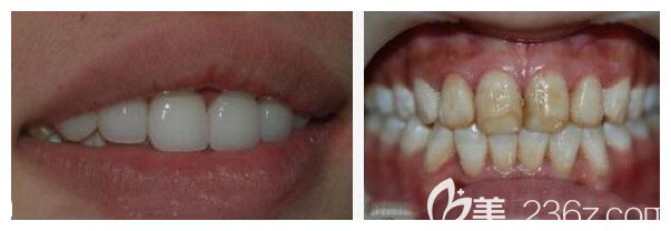 莫三心主任氟斑牙美容修復(fù)案例 莫三心主任氟斑牙美容修復(fù)案例