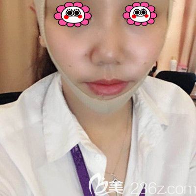 做完線雕后的第三天恢復(fù)圖 做完線雕后的第三天恢復(fù)圖