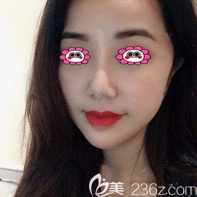 線雕提升一周后的圖片 線雕提升一周后的圖片